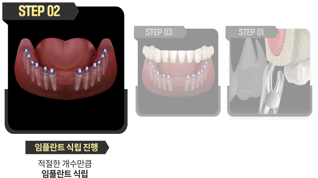 임플란트-식립-진행