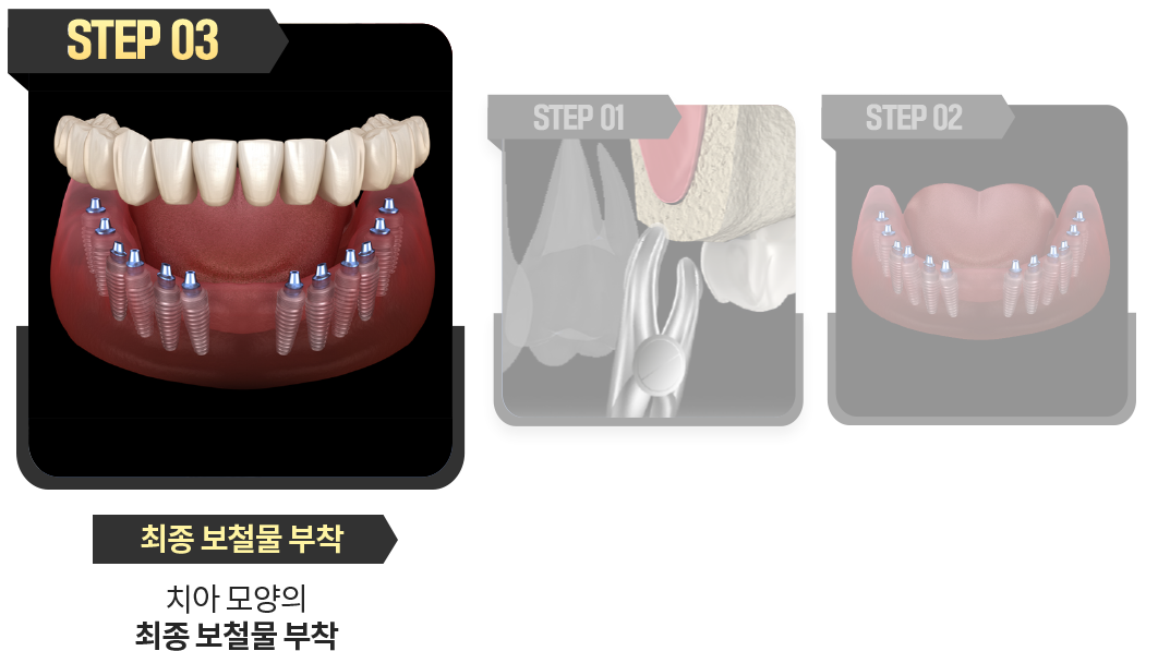 최종-보철물-부착