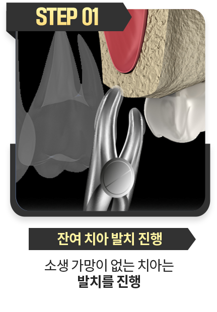 잔여-치아-발치-진행