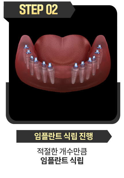 임플란트-식립-진행