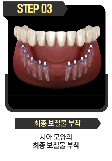 최종-보철물-부착